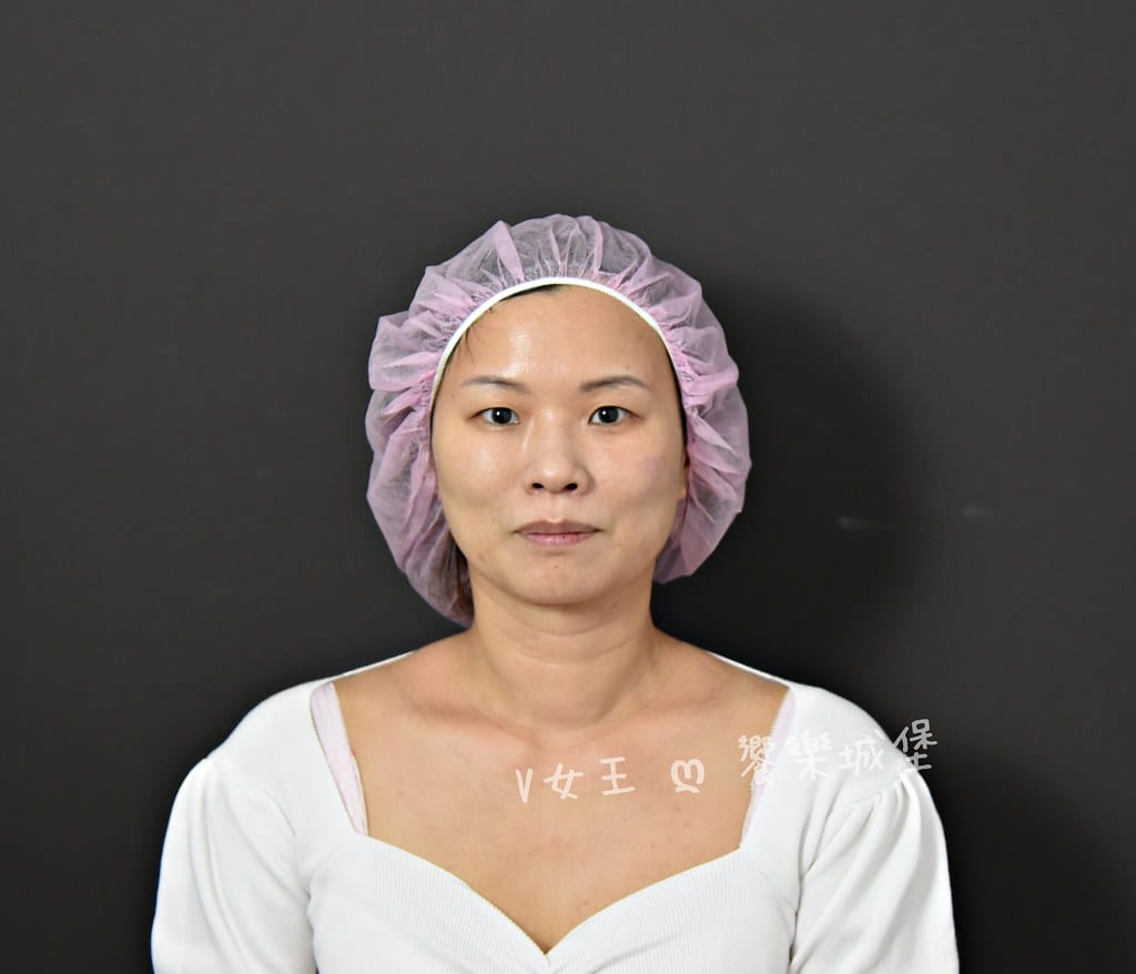 愛爾麗診所 板橋店 ll 𝐇𝐢𝐏𝐑𝐎-𝐒龍捲風音波 非侵入式